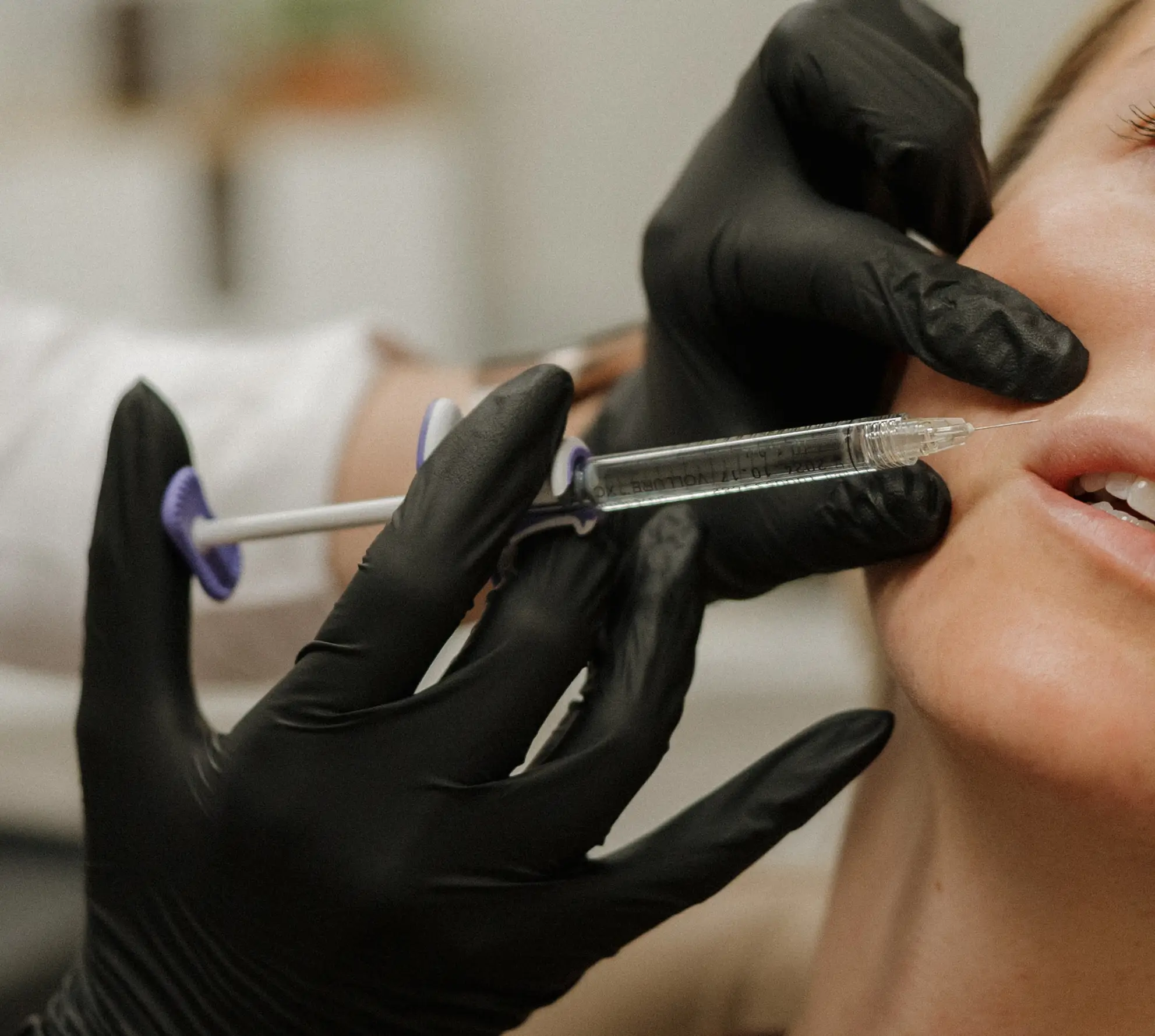 A healthcare professional wearing black gloves administers a cosmetic lip filler treatment to a client in a clinical setting. The practitioner uses a syringe to inject the filler into the client's lips, demonstrating a focus on aesthetic enhancement. The background features a clean and modern environment, emphasizing safety and professionalism in cosmetic procedures. This image highlights the growing trend of non-surgical beauty treatments and the importance of skilled practitioners in achieving desired results.