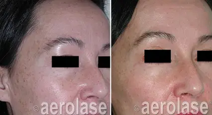 MicroPeel1 - Pair