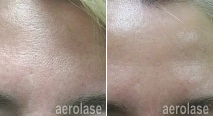 Micropeel2 - Pair