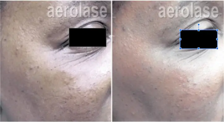 Micropeel3 - Pair