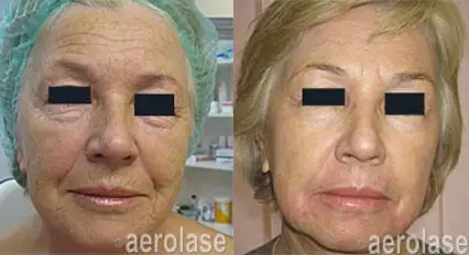 Skin-Resurfacing---Renew3