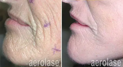 Skin-Resurfacing---Renew5