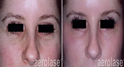 Sun Damage1 - Pair