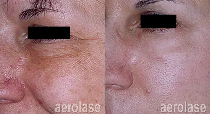 Sun Damage3 - Pair