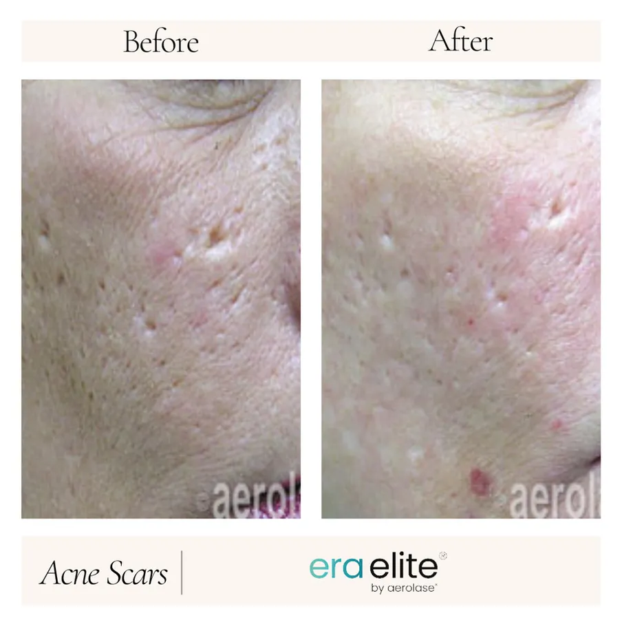 B&A - Acne Scars