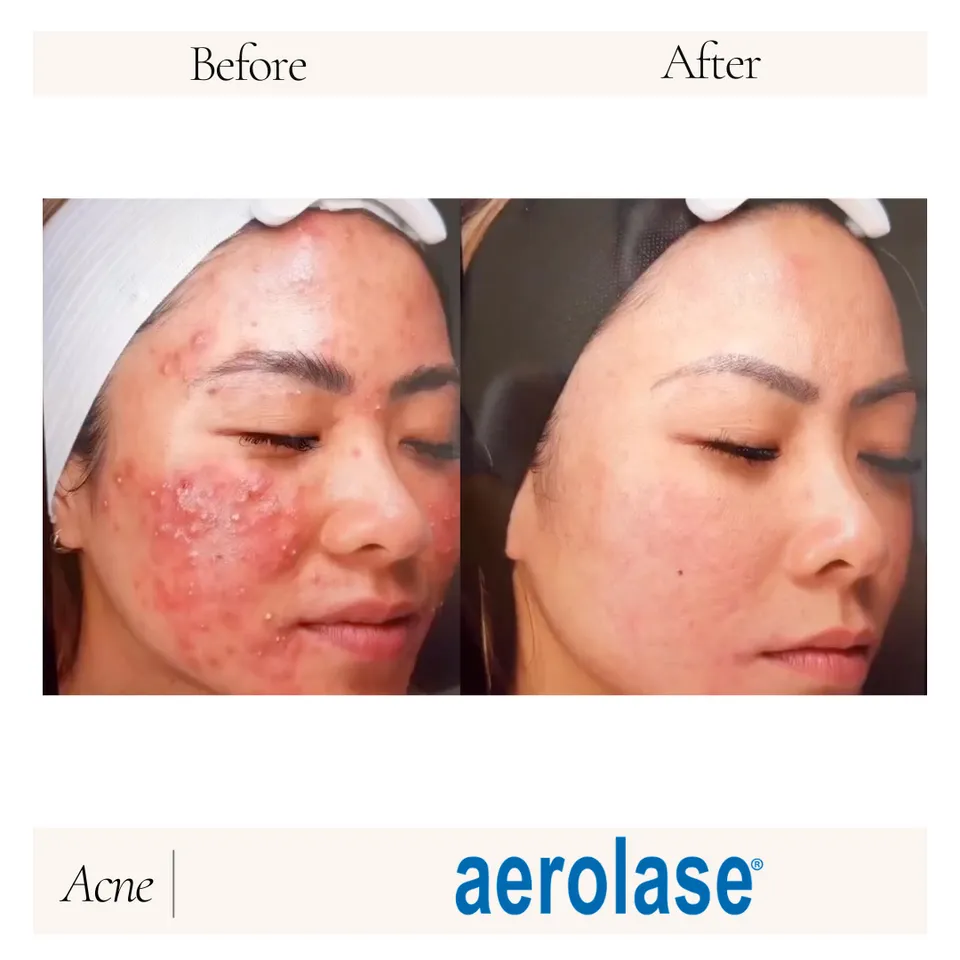 Before and after images showcasing the results of Aerolase treatment on facial skin, highlighting significant improvement in skin texture and reduction of acne scars.
