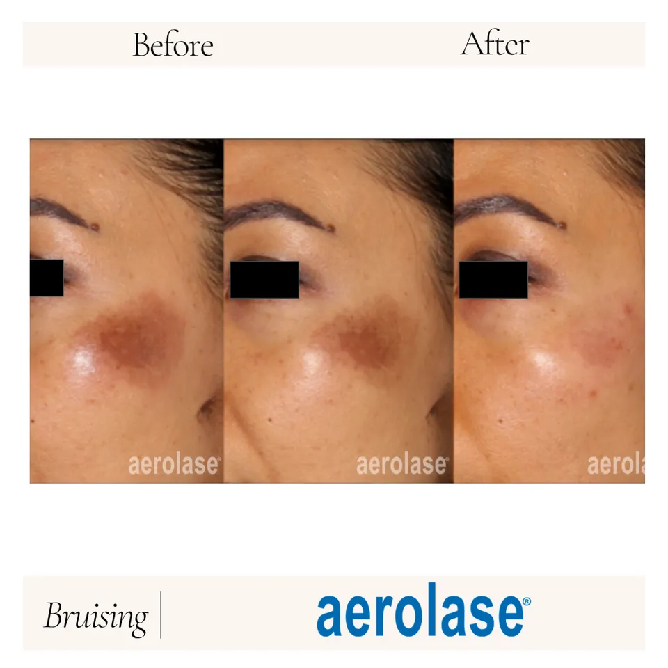 Before and after images showing the effects of Aerolase treatment on bruising around the eye area. The left image displays noticeable bruising, while the middle and right images illustrate significant improvement in skin tone and texture after treatment. This visual comparison highlights the effectiveness of Aerolase in reducing bruising and enhancing skin appearance. Ideal for patients considering skin treatments for bruising or discoloration.