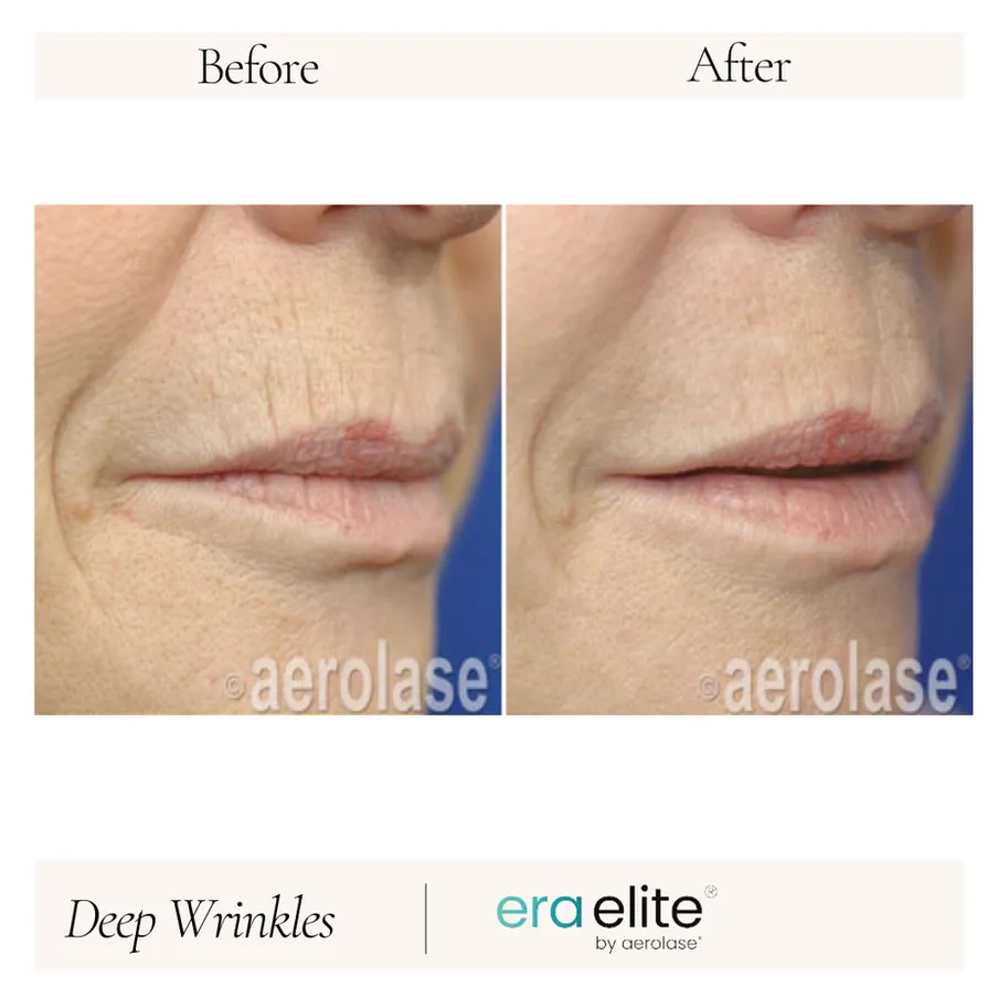 B&A - Deep Wrinkles