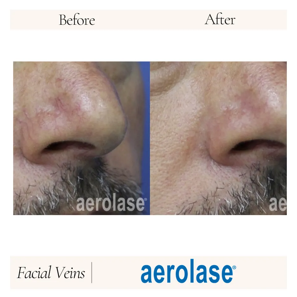 Close-up comparison of a man's nose before and after Aerolase treatment, highlighting significant skin improvements. The left side shows visible skin blemishes and uneven texture, while the right side demonstrates smoother skin with reduced imperfections. The image emphasizes the effectiveness of Aerolase in enhancing facial appearance.