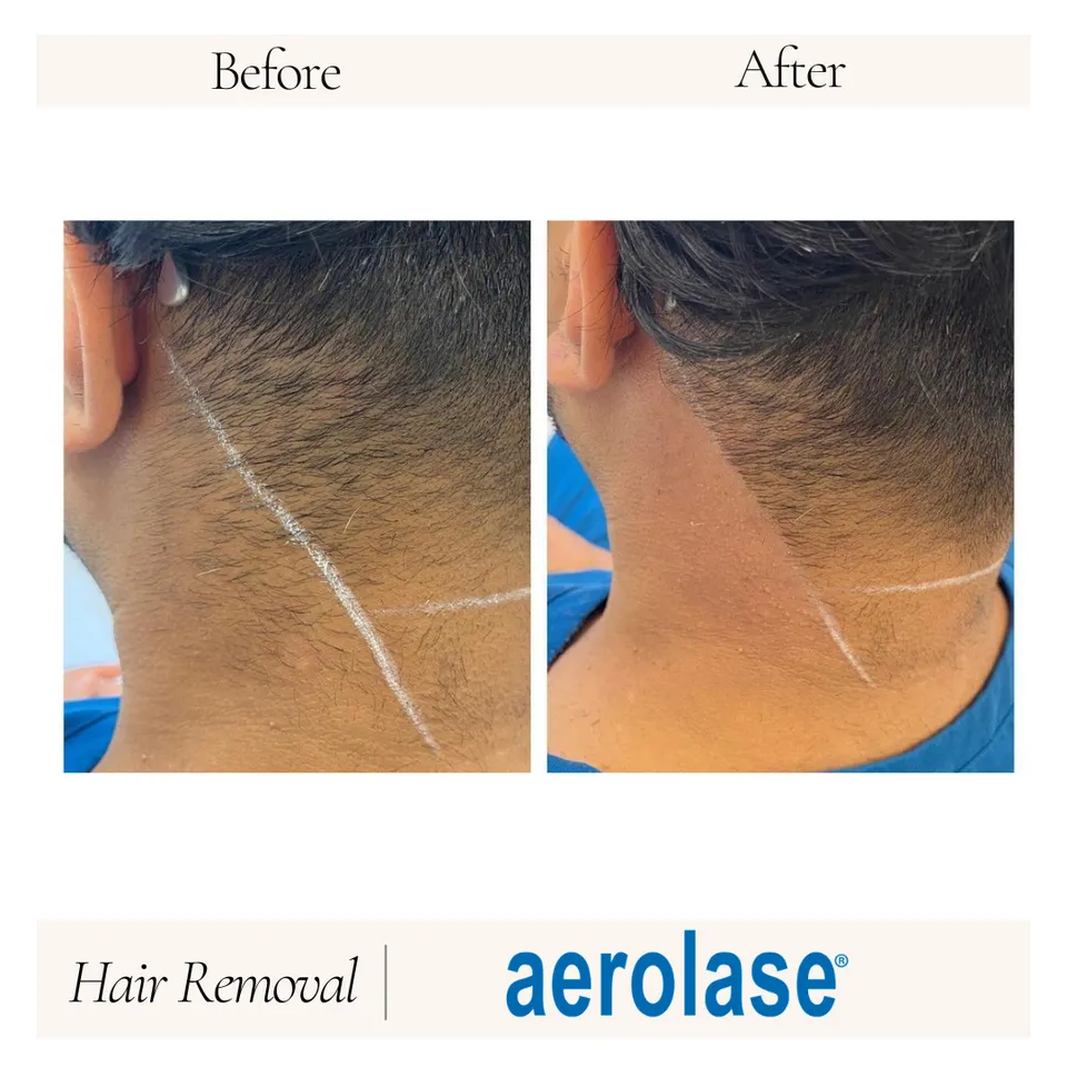 Before and after images demonstrating hair removal results on the nape of a person's neck using Aerolase technology. The "Before" image shows visible hair growth, while the "After" image highlights smooth skin with significantly reduced hair. The images illustrate the effectiveness of the Aerolase hair removal treatment, showcasing a clear transition from hair presence to a clean, hair-free appearance. This visual representation emphasizes the benefits of the treatment for individuals seeking effective hair removal solutions.