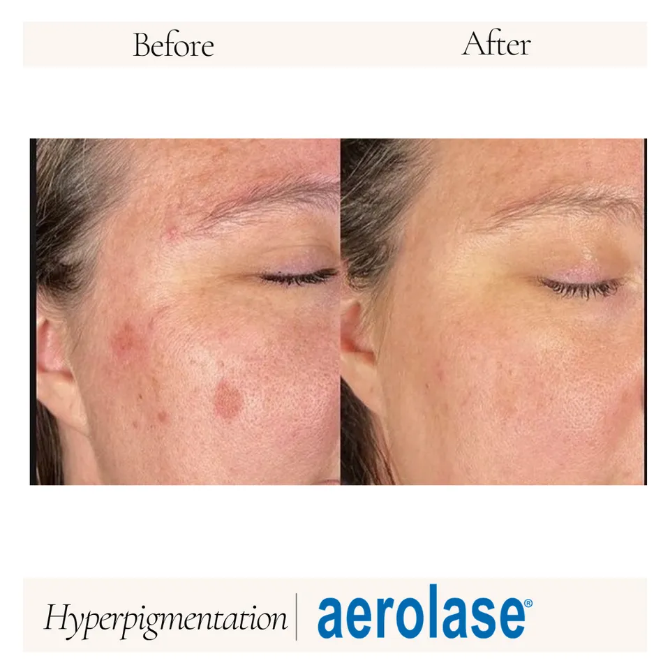 Before and after images showing the improvement of hyperpigmentation on a woman's face, demonstrating the effectiveness of Aerolase treatment.