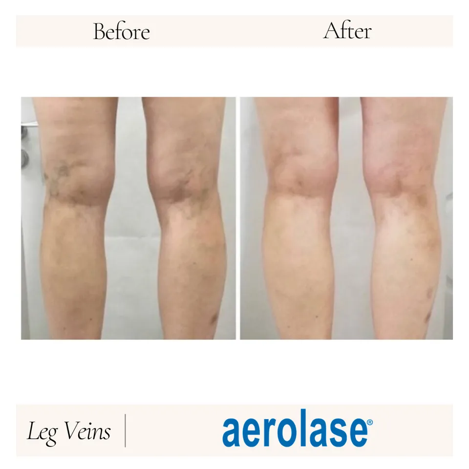 Image comparison showing the results of Aerolase treatment on the legs. The left side displays the "Before" image, highlighting uneven skin tone and visible imperfections around the knees. The right side presents the "After" image, showcasing improved skin clarity, reduced blemishes, and a smoother appearance. This visual demonstrates the effectiveness of Aerolase technology in enhancing skin texture and appearance. The image is labeled "Leg View" and features the Aerolase logo for branding.