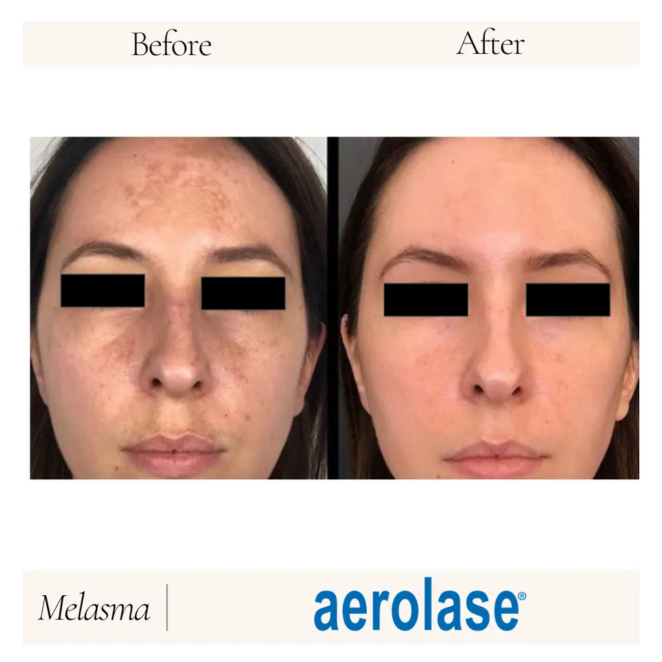 Before and after image showcasing the results of Aerolase treatment for skin improvement, highlighting significant reduction in uneven skin tone and texture.