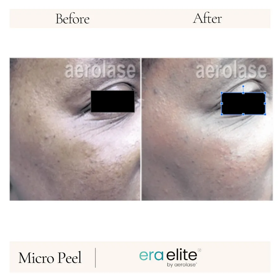 B&A - Micro Peel