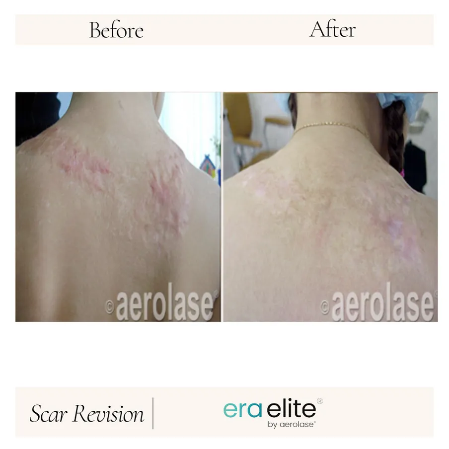 B&A - Scar Revision