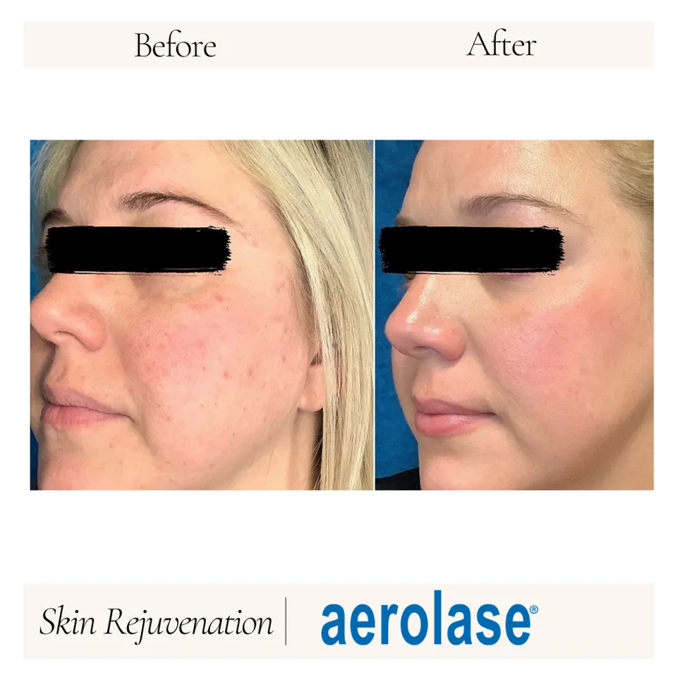 Before and after images showcasing the results of Aerolase skin rejuvenation treatment. The left side displays the skin condition prior to treatment, highlighting uneven texture and blemishes. The right side illustrates the improved skin appearance post-treatment, with smoother texture and reduced imperfections. This visual comparison emphasizes the effectiveness of Aerolase technology in enhancing skin quality and rejuvenation. Ideal for individuals seeking non-invasive skin treatment options.