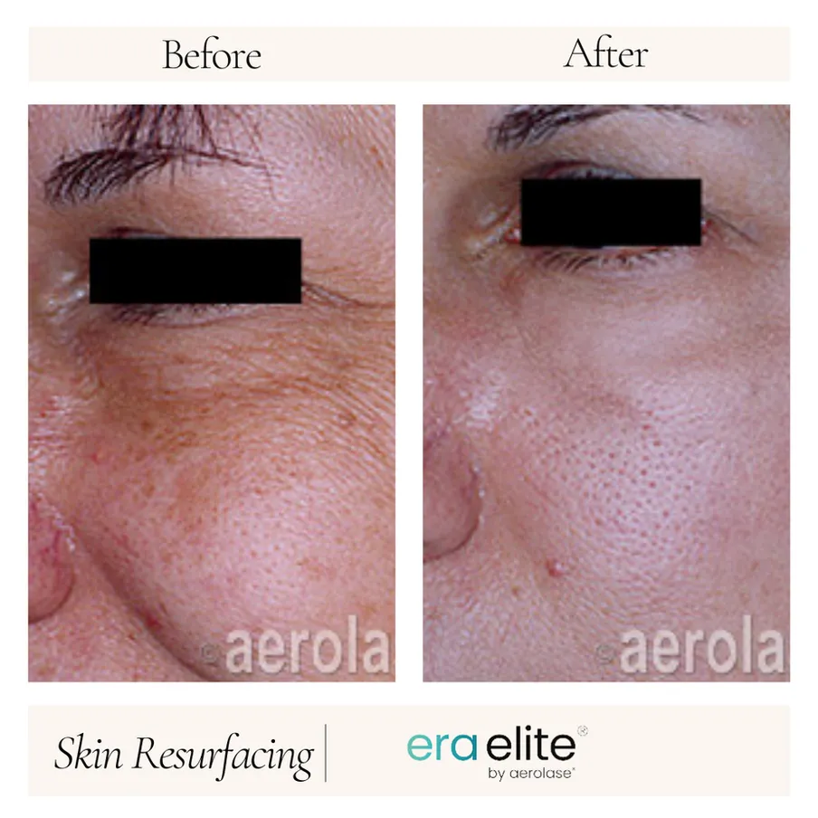 B&A - Skin Resurfacing