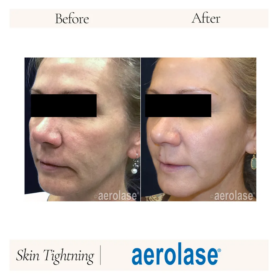 Before and after image showcasing the results of Aerolase skin tightening treatment. The left side displays the "before" condition, highlighting sagging skin and wrinkles, while the right side presents the "after" results, demonstrating visibly firmer and smoother skin. The image emphasizes the effectiveness of non-invasive skin tightening procedures. Aerolase logo and the term "Skin Tightening" are included for branding. This visual serves as a testament to the transformative effects of advanced skincare technology, appealing to potential clients seeking