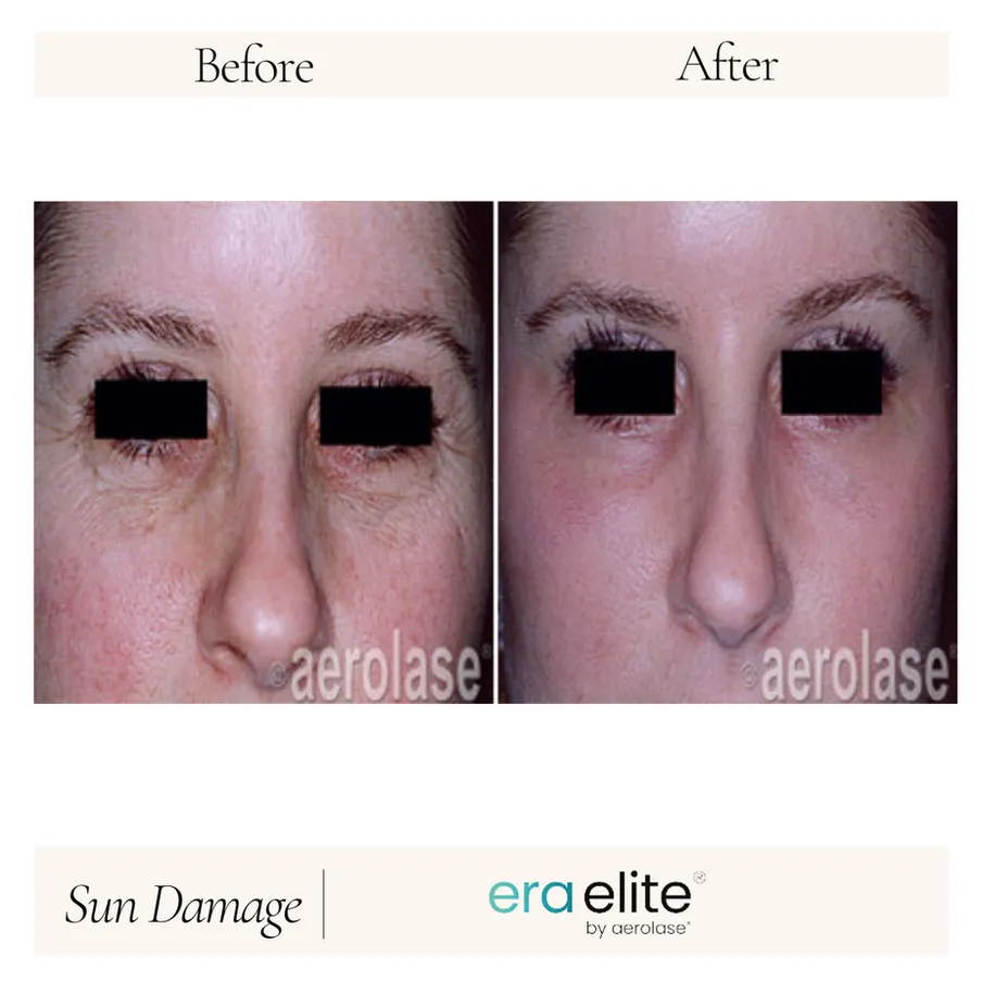 B&A - Sun Damage