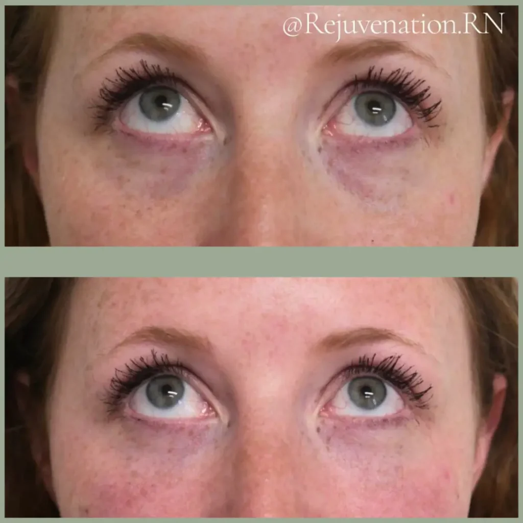 Before and after comparison of a woman's eyes showing the effects of a cosmetic treatment. The top image displays noticeable dark circles and puffiness, while the bottom image shows a significant reduction in these issues, highlighting a brighter and smoother appearance. The woman's expression remains neutral in both images, emphasizing the treatment's effectiveness without altering her natural features. This visual demonstrates the potential benefits of cosmetic procedures for enhancing under-eye appearance.
