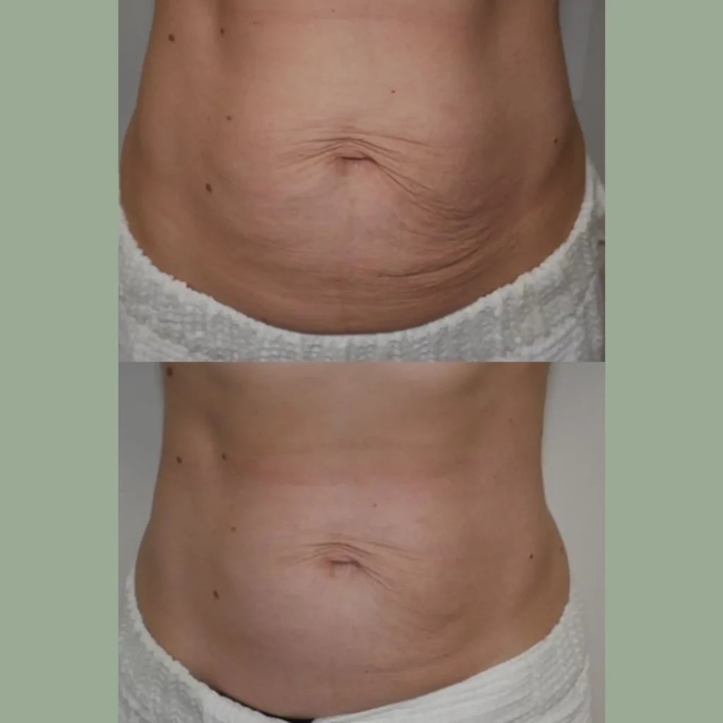 Before and after images of a person's abdomen showing skin texture changes and reduced appearance of stretch marks. The top image displays a more pronounced belly with visible skin laxity, while the bottom image shows a smoother and firmer abdomen.