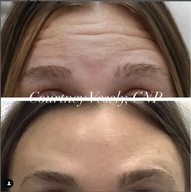 Botox B&A (2)