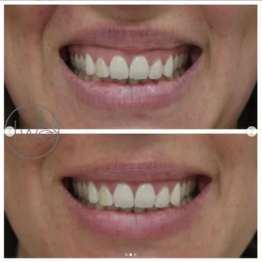 Botox B&A (3)