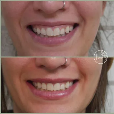 Botox B&A (4)