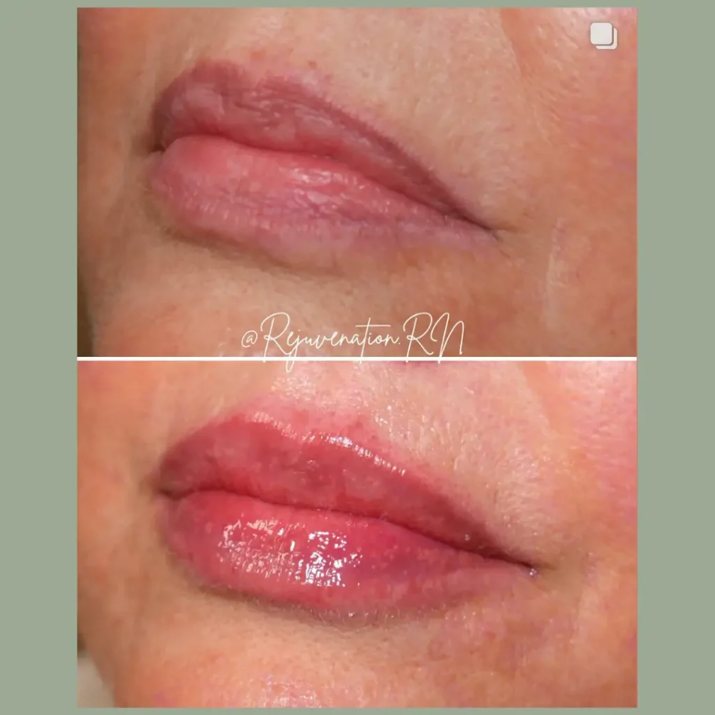 Before and after comparison of lip enhancement treatment, showcasing fuller and more defined lips with a glossy finish.