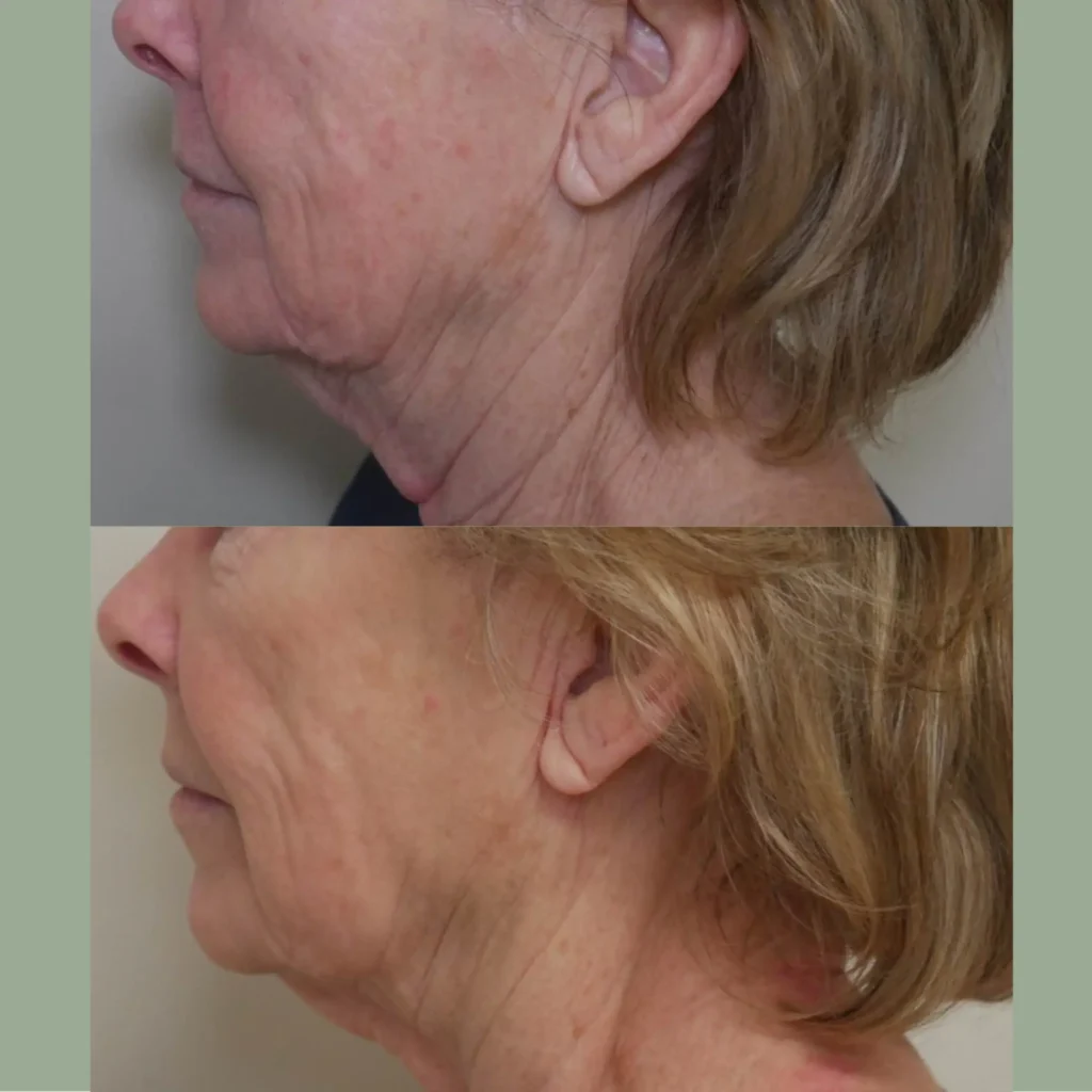 Before and after photos showing the side profile of a woman highlighting improvements in skin tightness and facial contours, illustrating the effects of a cosmetic treatment or procedure.