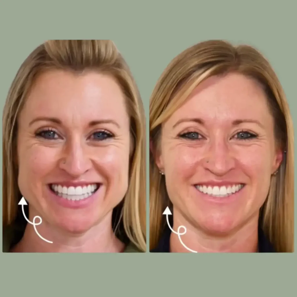 Before and after comparison of a woman's smile transformation, showcasing enhanced dental aesthetics and facial symmetry.