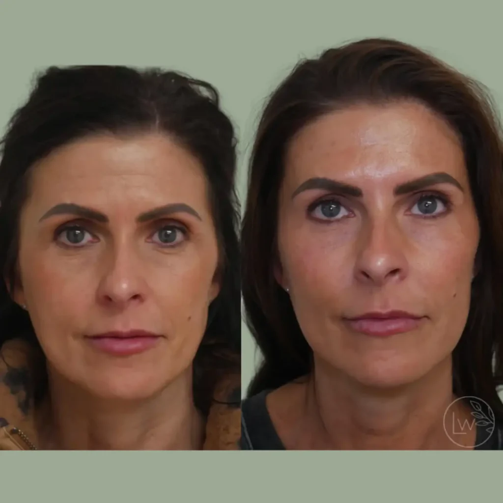 Before and after comparison of a woman's facial appearance, showcasing changes in skin tone, texture, and overall facial symmetry. The left side displays the original look, while the right side demonstrates the results after a cosmetic treatment.