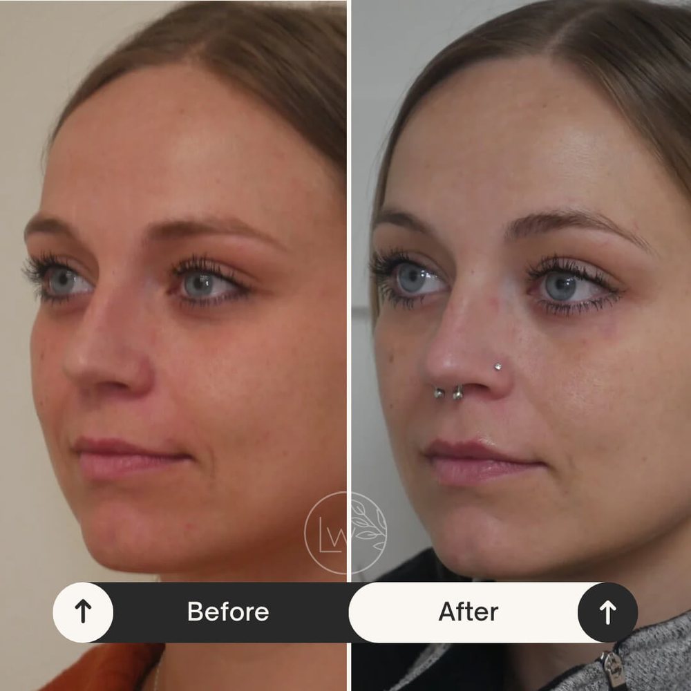 Botox before and after