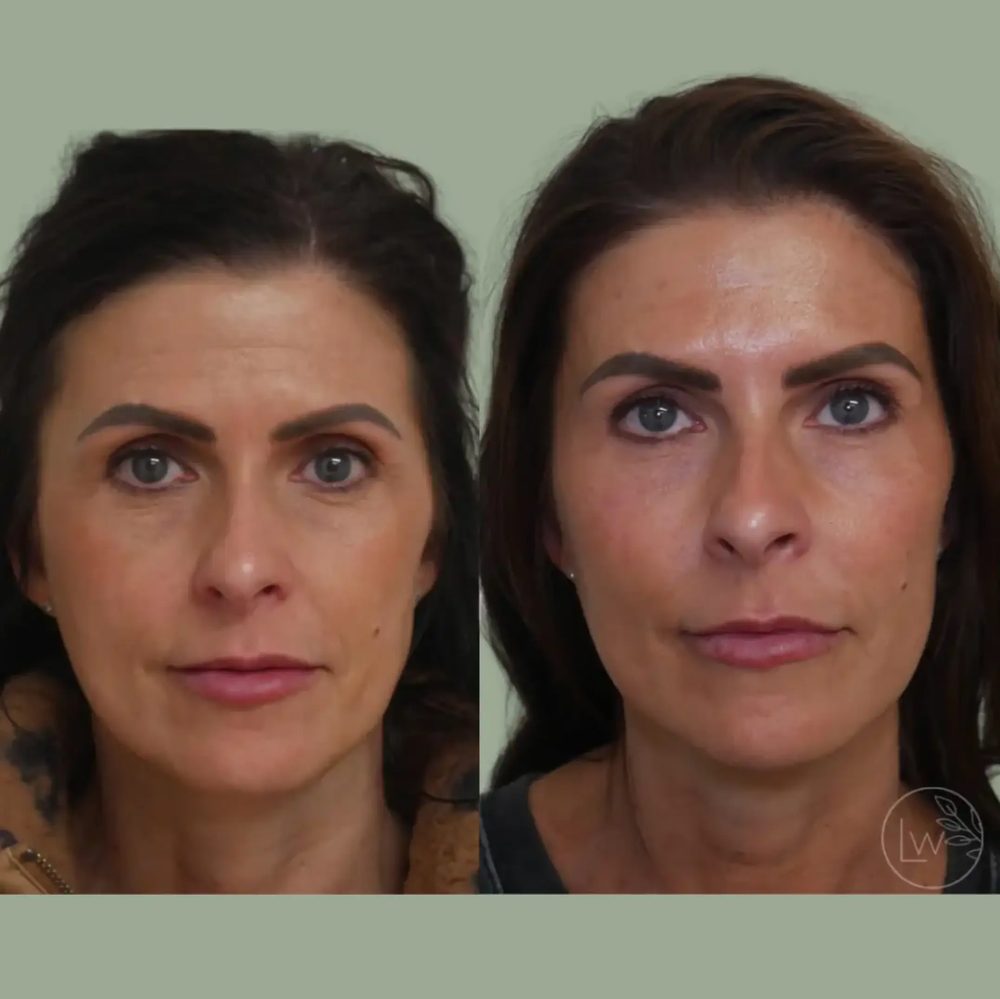 Dermal filler before and after