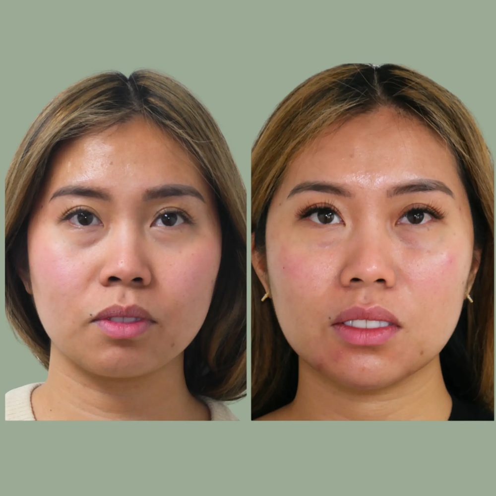 Kybella before and after