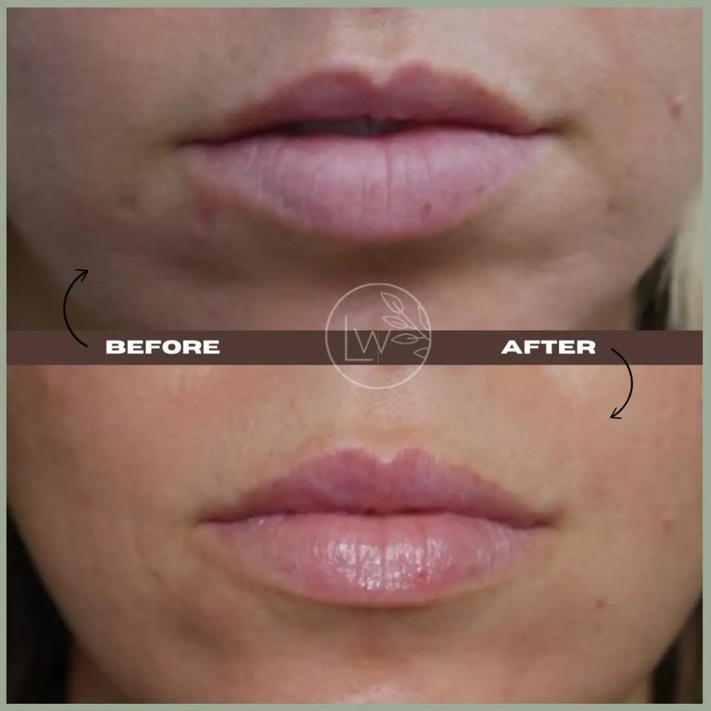 Lip filler before and after