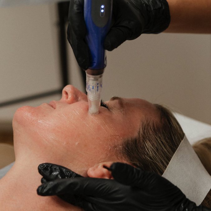 Microneedling texture and skin quality result