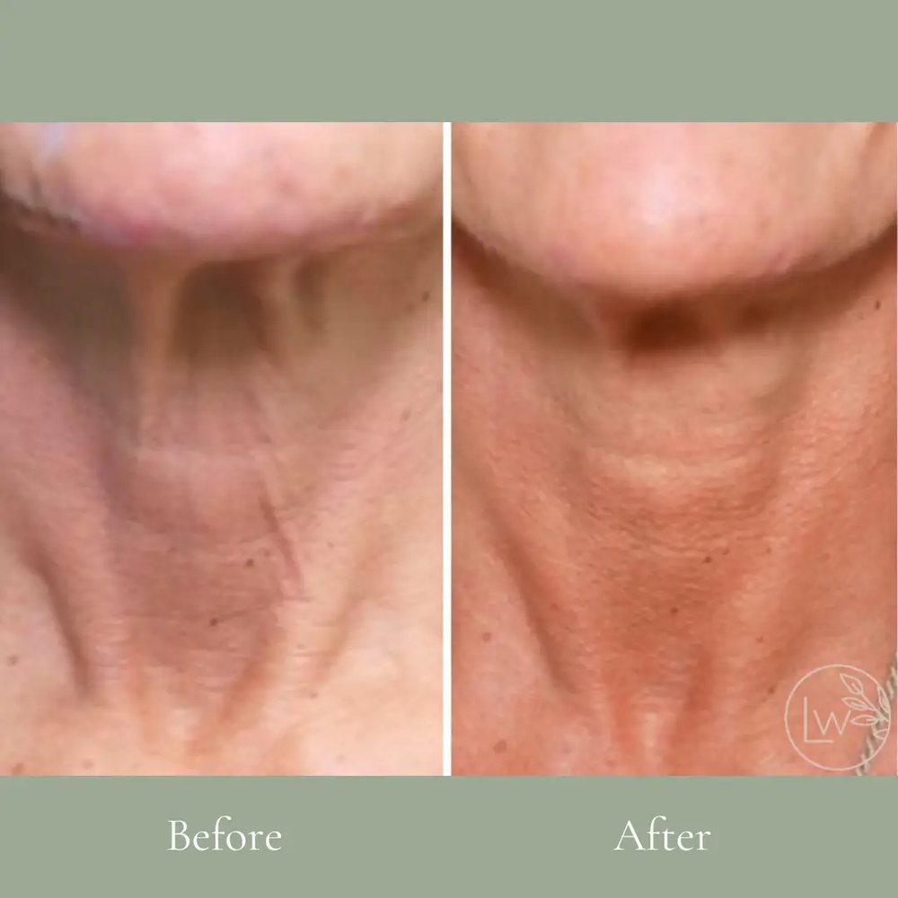 Radiesse before and after