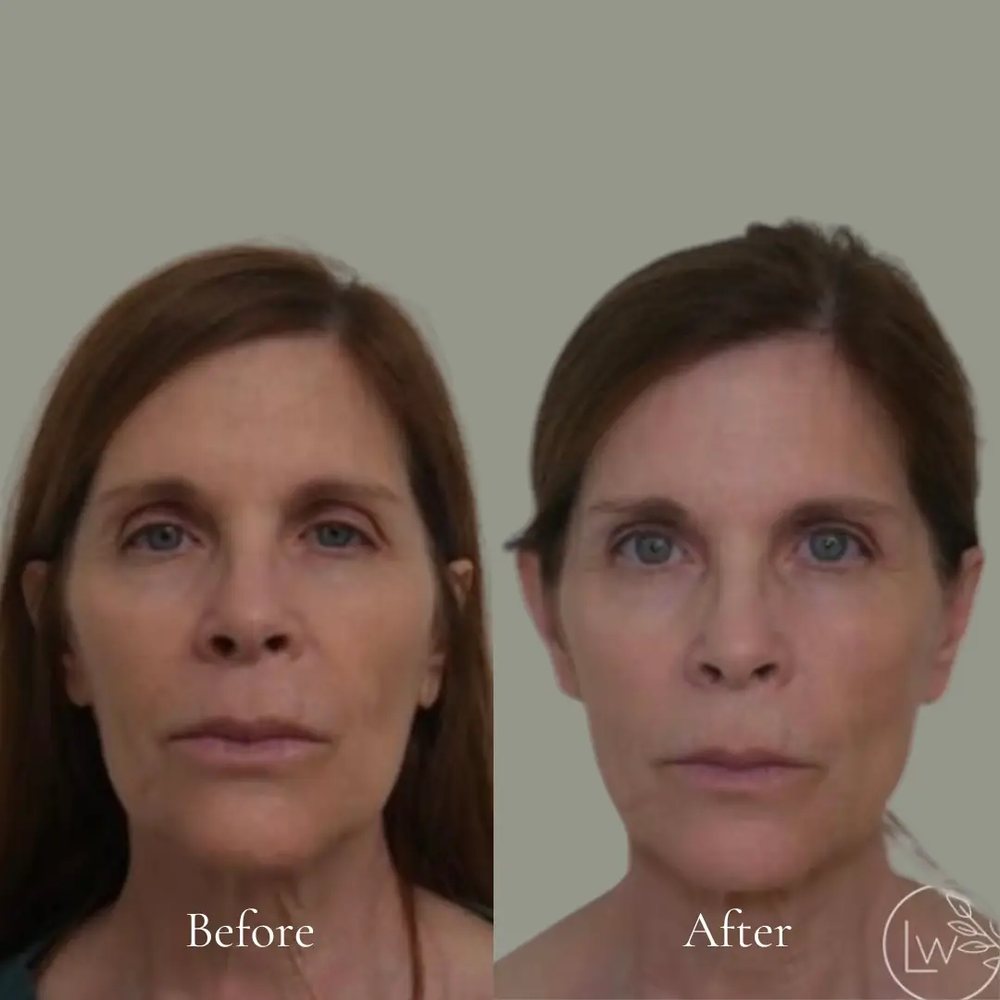 Sculptra before and after