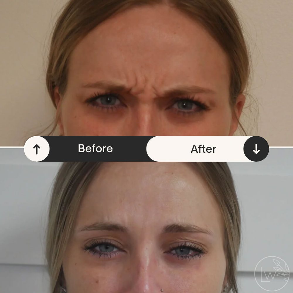 Botox forehead and frown lines before and after