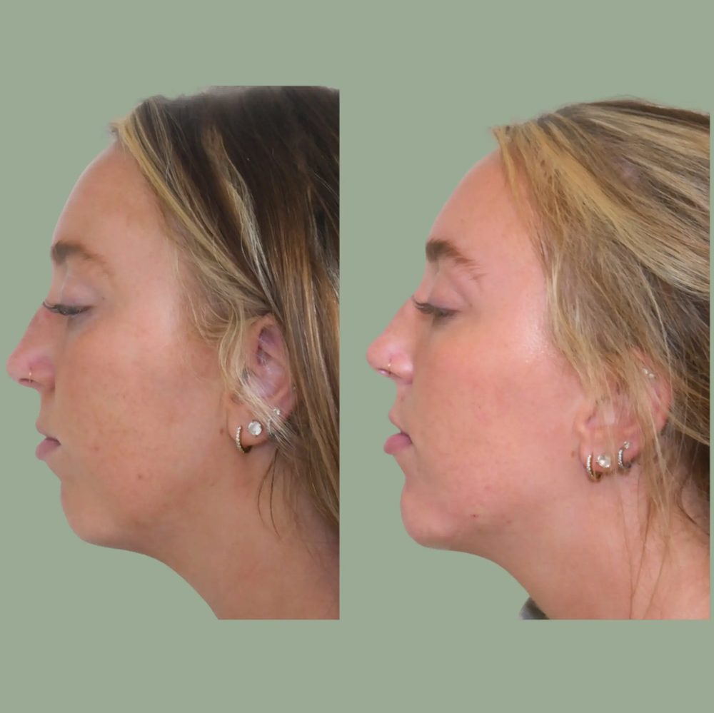 Dermal filler cheek and midface before and after