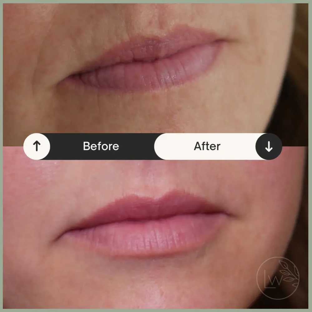 Lip filler natural proportion before and after